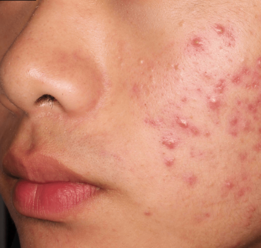 Before-and-after images of a CABTREO patient