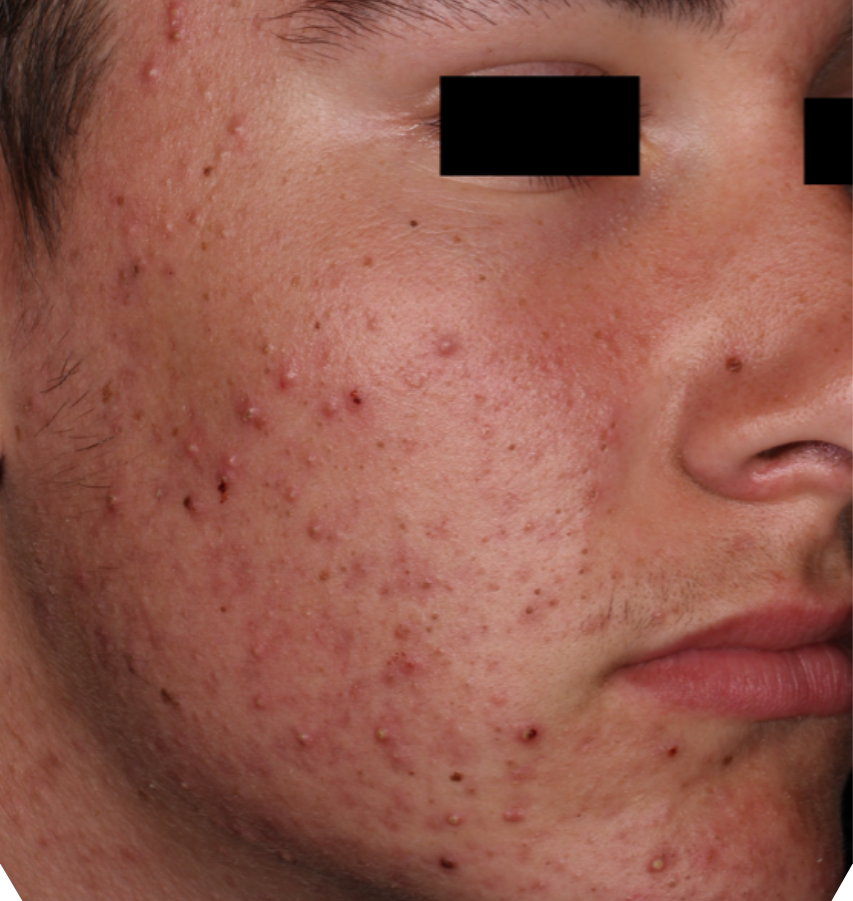 Before-and-after image of CABTREO patient