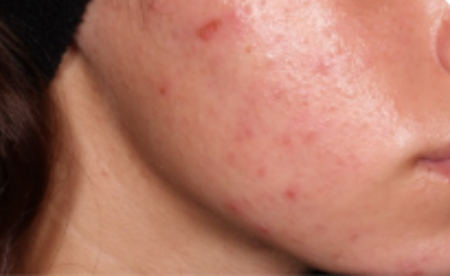 Before-and-after images of a CABTREO patient