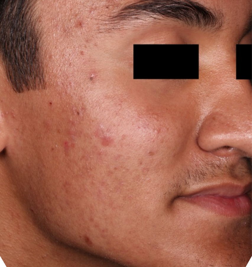 Before-and-after image of CABTREO patient