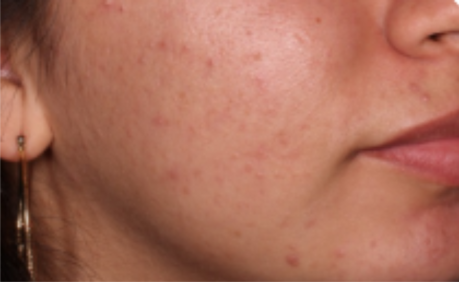 Before-and-after images of a CABTREO patient