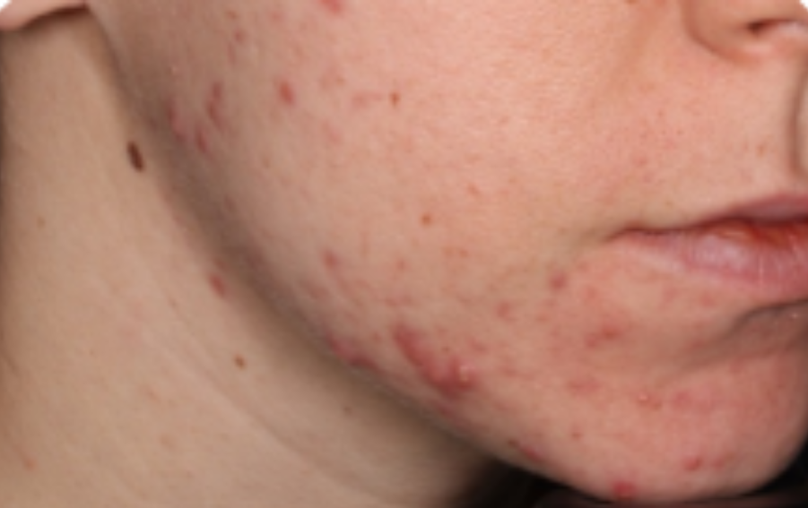 Before-and-after images of a CABTREO patient