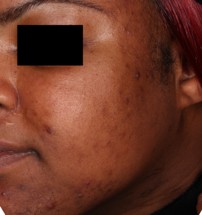 Before-and-after image of CABTREO patient