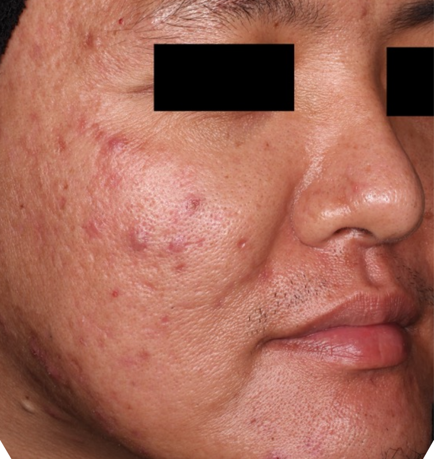Before-and-after image of CABTREO patient