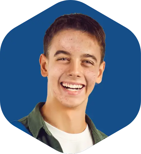 Actor portrayal of an acne patient who could be treated with CABTREO. Not an actual patient.