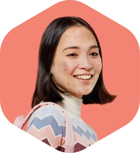 Actor portrayal of an acne patient who could be treated with CABTREO. Not an actual patient.